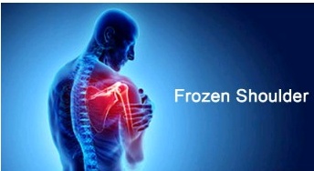 Apa Itu Frozen Shoulder, Kenali Gejala Dan Penanganannya – MIN.CO.ID